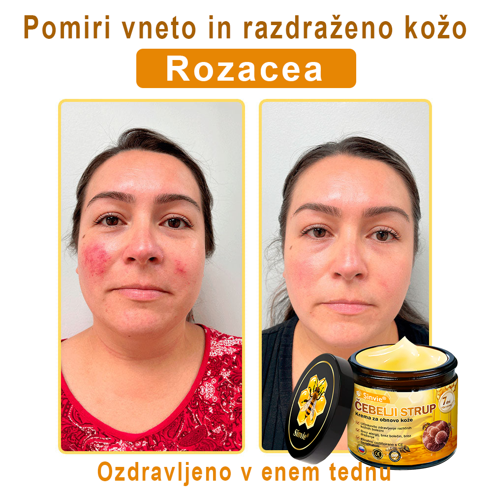 👩‍⚕️👩‍⚕️Sinvie® krema s čebeljim strupom | 50 ml | Profesionalna formula za nego in obnovo kože