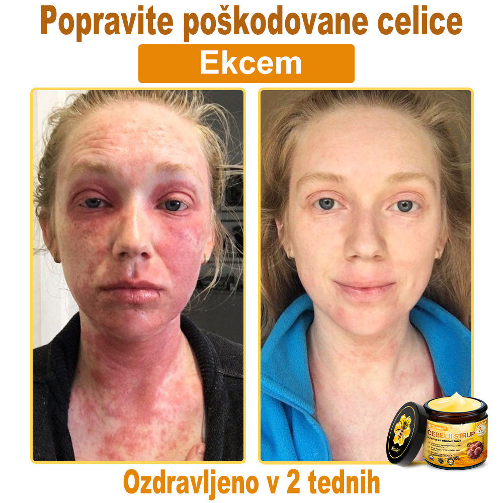 👩‍⚕️👩‍⚕️Sinvie® krema s čebeljim strupom | 50 ml | Profesionalna formula za nego in obnovo kože