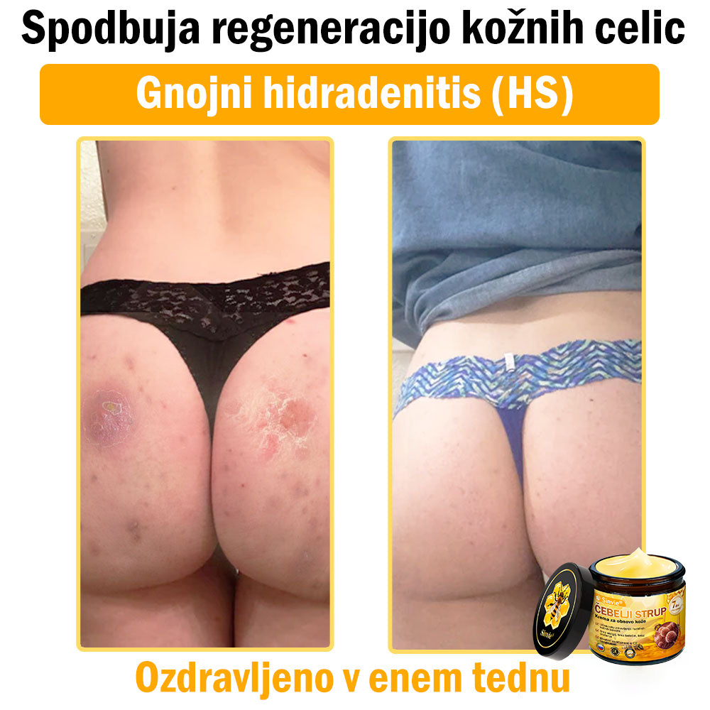 🎁Sinvie® Na voljo je samo še 5 škatel! Zagotovite si dodatnih 50 % popusta.    Če zamudite zdaj, takšne priložnosti prihodnje leto morda ne bo več.